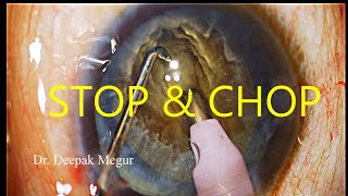 Phaco Basics  Stop amp Chop Technique in a hard Cataract [upl. by Deirdre159]