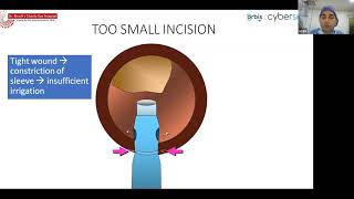 Live Surgical Demonstration Basics of Phacoemulsification  Dr Umang Mathur [upl. by Zinah405]