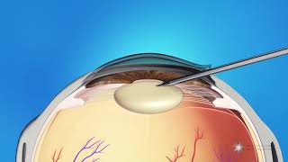 Phacoemulsification Cataract Surgery [upl. by Merrielle]