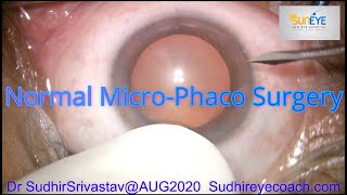 Normal MICSMicroPhacoemulsification Cataract Surgery DR SUDHIR SRIVASTAVA [upl. by Anyt176]