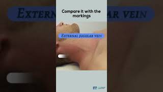 Examination of Jugular Venous Pulse [upl. by Anilrac]