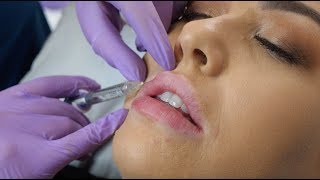 Lip Fillers  what to expect during the procedure  The Laser amp Skin Clinic [upl. by Ahseen]