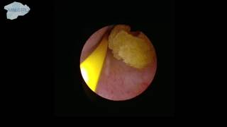 Localization of the ureter stone [upl. by Nilo912]