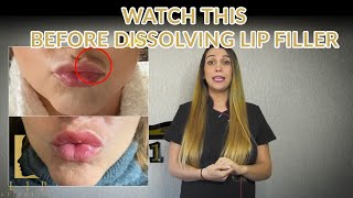 This You Should Know Before Dissolving Lip Filler  L1P AESTHETICS [upl. by Lanette227]