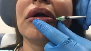 Reversing poorly placed lip filler using Hylenex hyaluronidase [upl. by Booker]