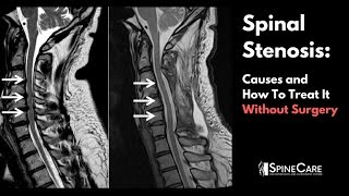 Spinal Stenosis Causes and How to Treat It Without Surgery [upl. by Ikcin]