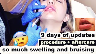 LIP FILLERS  First time tips for faster healing [upl. by Ener]