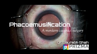 Phacoemulsification Procedure Explained  Ultramodern Cataract Surgery [upl. by Haelem532]