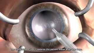 Phacoemulsification Cataract Surgery [upl. by Ybrik]