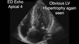 Hypertrophic Obstructive Cardiomyopathy with SAM [upl. by Enimisaj941]