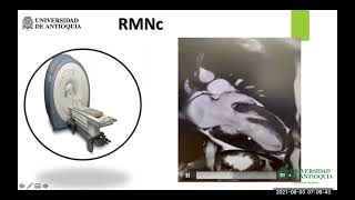 Hipertrofia Ventricular Izquierda Abordaje Clínico  Dr Jhon Fredy Salamanca [upl. by Abagael]