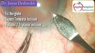 quotMain Wound Incisionquot during Phacoemulsification Cataract surgery Remake [upl. by Weide]