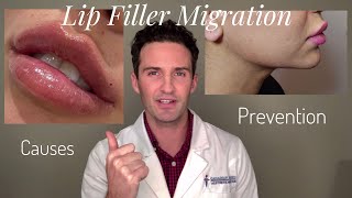 Lip Filler Migration Causes amp Prevention [upl. by Russian]