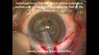 iH during phacoemulsification cataract surgery  ID 124528 [upl. by Buttaro]