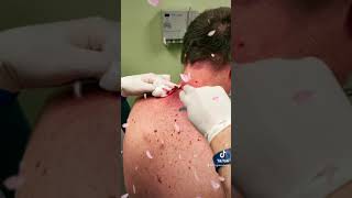 Dr Greenberg Cyst Follow up video 🎥 with Las Vegas Dermatology® incision amp drainage procedure 💉 🔪 [upl. by Cleopatra]