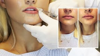 Lip Filler Experience  Start to Finish with 1 Syringe of Juvederm [upl. by Ralleigh491]